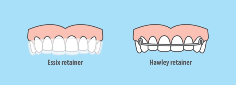 Types of retainers