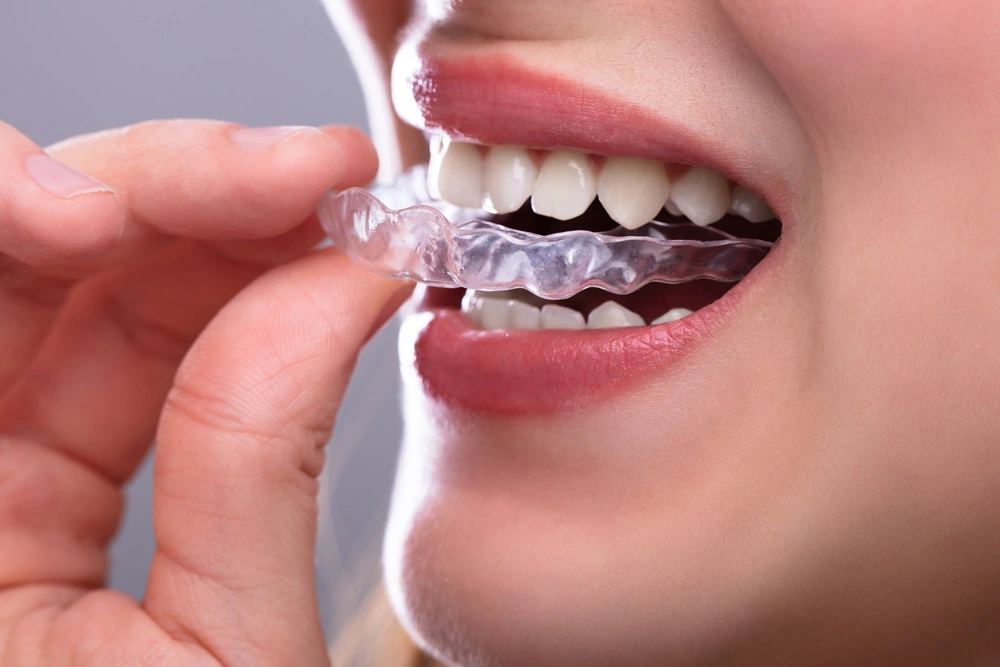Close-up Of A Woman's Hand Putting Transparent Aligner In Teeth