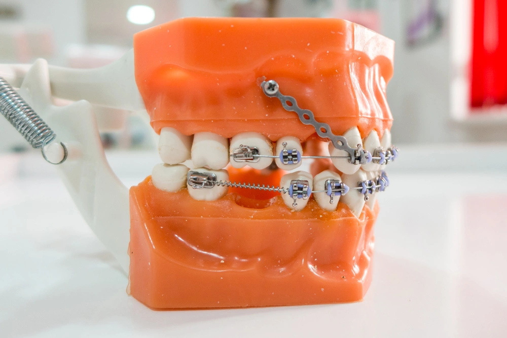 Orthodontic typodont with metal braces and mini screws tooth extraction treatment