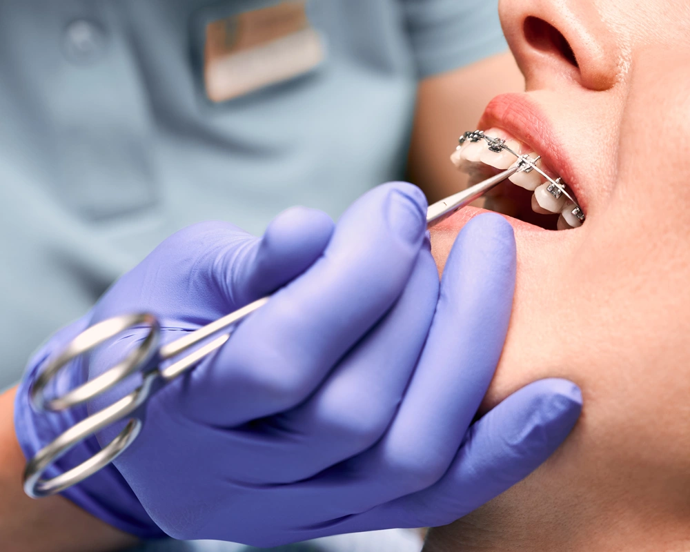 Close up of dentist hand putting elastic rubber band on patient brackets.