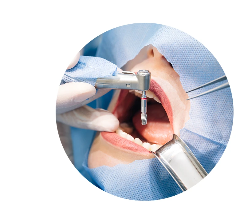 Close-up shot of attentive doctors performing surgical operation installing dental implants into patient's mouth in modern dental clinic