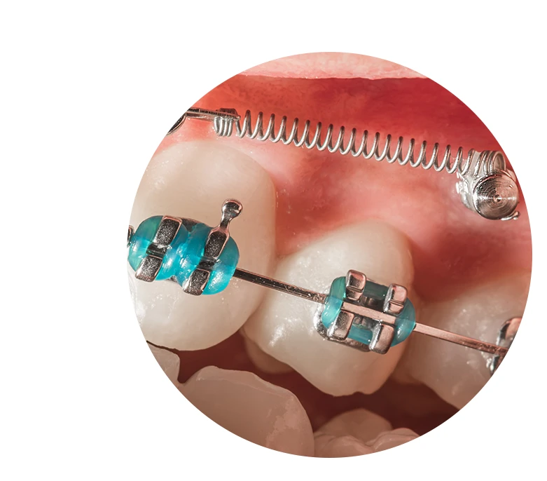 A close-up photo shows cyan-colored orthodontic braces with an implant anchor.